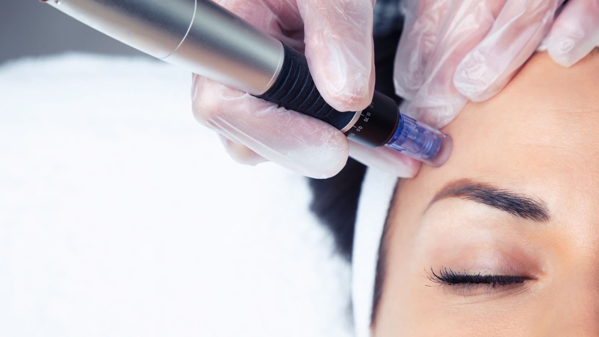 Dermapen & Otolog Fibroblast