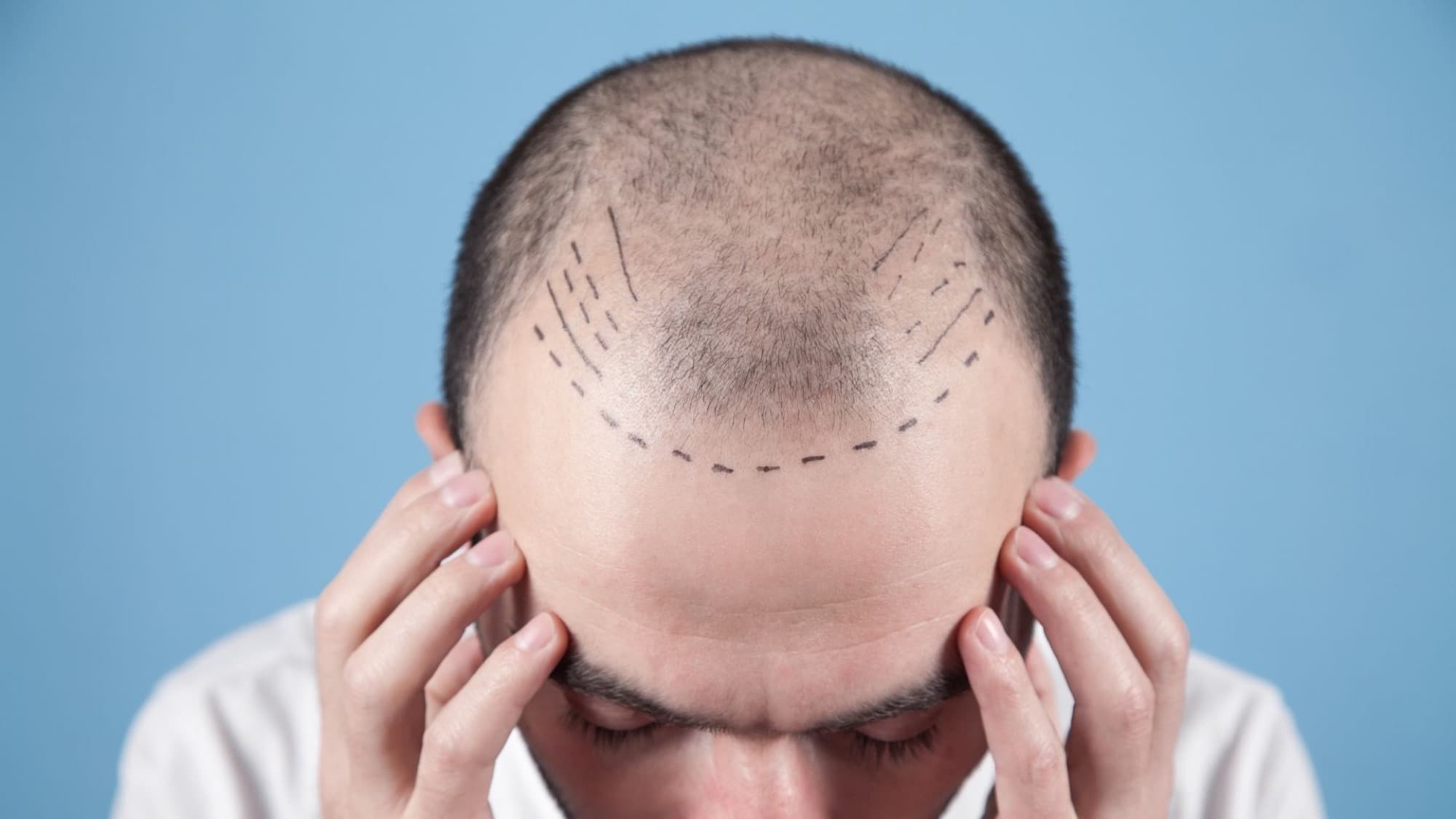 Hybrid Hair Transplant