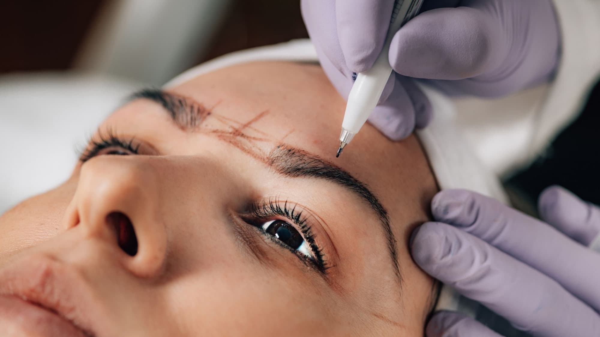 Eyebrow Transplant