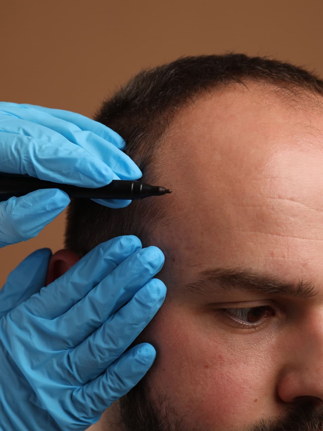 What is a Sapphire FUE hair transplant?